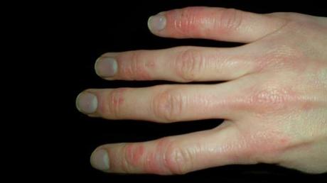 What is Scleroderma? Causes, Symptoms and Treatment