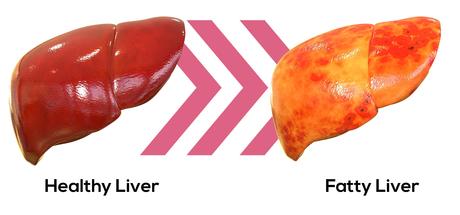 Home Remedies for Fatty Liver