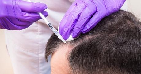 Management of Hair Loss