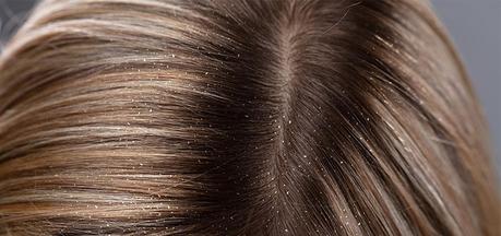 Skip the Embarrassment and Learn How to Treat Your Dandruff