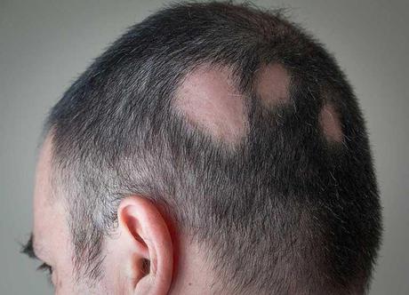 alopecia-areata