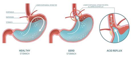 Best Natural Treatment Acidity or acid Reflux