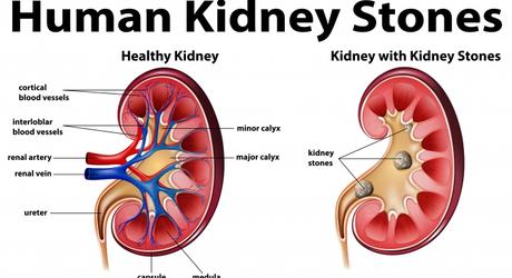 Kidney Stones Causes - kidney stone pain