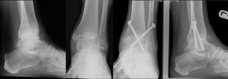 What is Ankle Fusion? Dr. Matthew Hyzy Answers