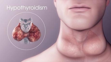 What is Hypothyroidism? What is the Herbal Treatment to cure it Naturally?