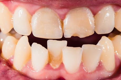 The Top 10 Dental Problems That Can Be Fixed By Braces In 2020