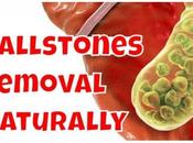 What Gallbladder? Remove Gall Stones Naturally?