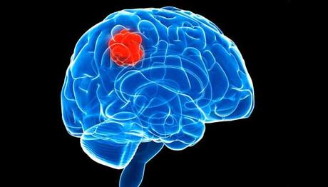 What is Brain Tumor? Causes, Signs and Ayurvedic Treatment to Cure