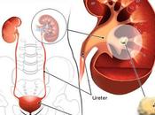 Kidney Stones: Powerful Natural Remedies Overcome Them