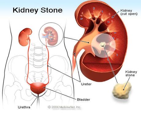 Kidney Stones: 5 Powerful Natural Remedies To Overcome Them