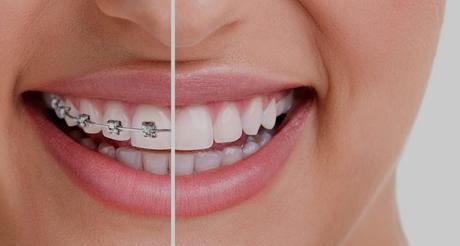 Do You Need To See An Orthodontist To Straighten Your Teeth?