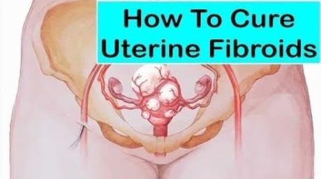 Uterine Fibroid Ayurvedic and Herbal Treatment