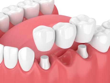 What is Dental Bridges