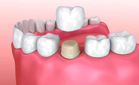 What is Dental Crowns