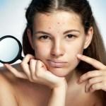 blackhead-removal-how-to-get-rid-of-blackheads