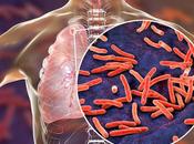 Tuberculosis, Types Causes, Symptoms Treatment