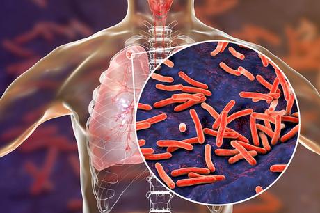 Tuberculosis, Types , Causes, Symptoms and Treatment