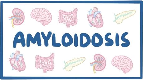 What is Amyloidosis? How to cure it Naturally