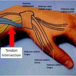 Intersection Syndrome: An Important Cause of Wrist Pain You Need to ...
