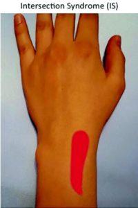 Intersection Syndrome: An Important Cause of Wrist Pain You Need to Know!