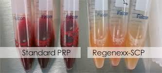 What to Expect After PRP Injection: Keys You Need to Know!
