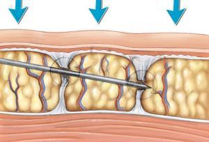 subcision needle subcision needle