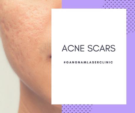 laser treatment for acne