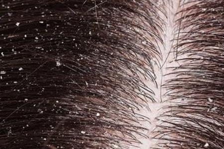 How to Get Rid of Scalp Infection and Severe Dandruff Naturally?