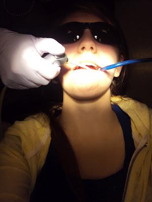 Taking Off My Braces