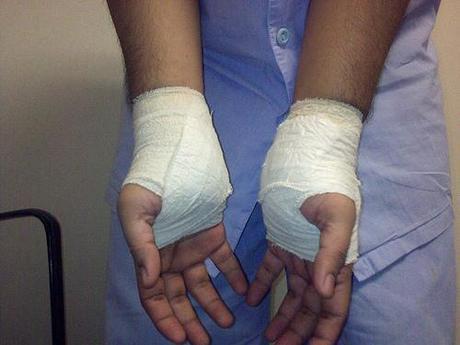 Carpal Tunnel Syndrome
