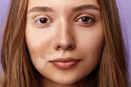 4 Natural Ways To Remove Pigmentation & Dark Spots