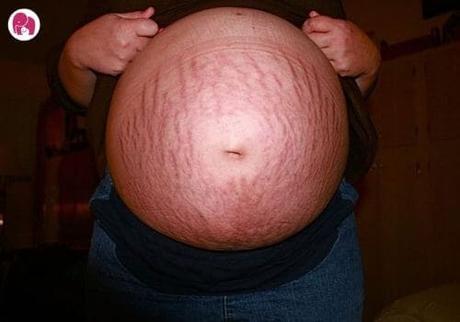 Stretch Marks During and After Pregnancy | Cause and Cure For Stretch Marks