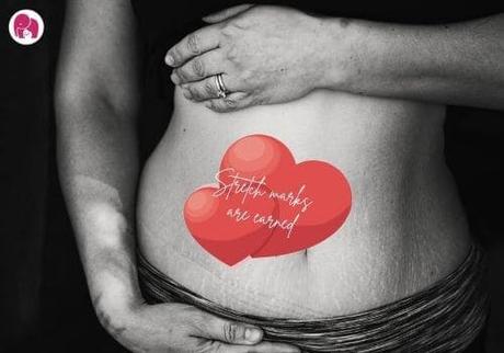 Stretch Marks During and After Pregnancy | Cause and Cure For Stretch Marks