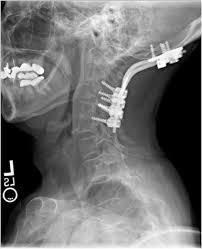 Cranial Cervical Instability: Canadian Rancher Back in Saddle After Upper Cervical Stem Cell Procedure