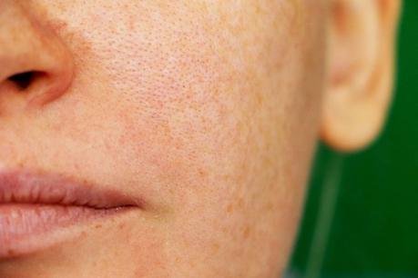 5 All-Natural Treatments for Large Pores