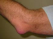 What Bursitis? Causes, Types, Symptoms Ayurvedic Treatment