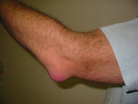 What is Bursitis? Causes, Types, Symptoms and Ayurvedic Treatment