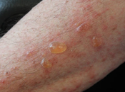 Herbal Remedies Bullous Pemphigoid
