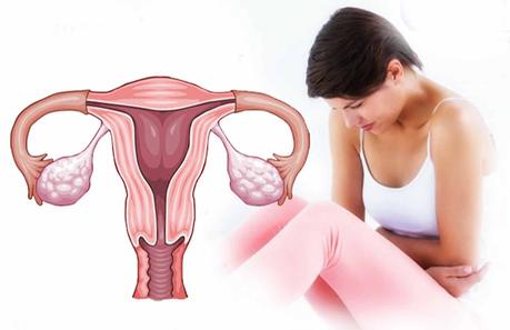 How to Cure Dysfunctional Uterine Bleeding Naturally?