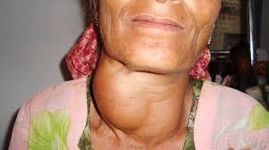 Goiter – Herbal and Natural Treatment