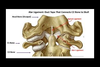 craniocervical instability cervical rancher cranial