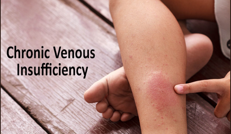 Ayurvedic Treatment of Chronic Venous Insufficiency