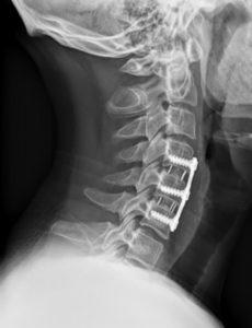 three level cervical fusion surgery