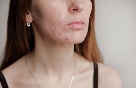 5 Things to Do to Help Your Acne Go Away for Good!