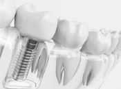 Many Dental Implants Will Need?