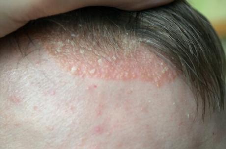 Scalp Treatment for Eczema
