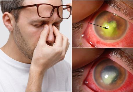 Herbal Remedies for Reis Buckler Dystrophy – Eye Disorder