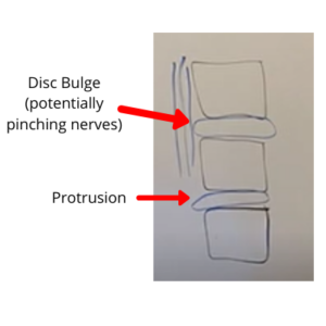 disc bulge and protrusion in spine - herniated disc