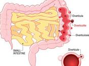 Diverticulitis Low-carb Diet