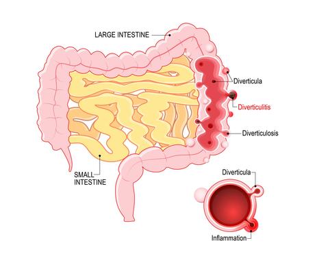 Diverticulitis and the low-carb diet